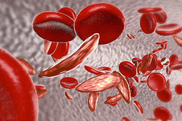 Na anemia falciforme, as hemácias adquirem um formato de foice.