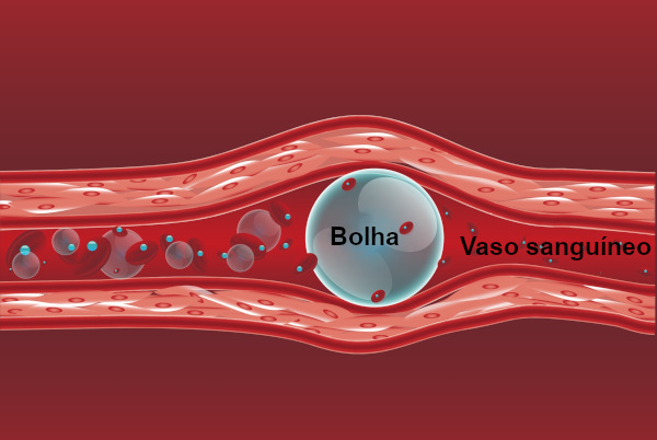 Na embolia gasosa, observa-se a presença de gás no interior dos vasos sanguíneos.
