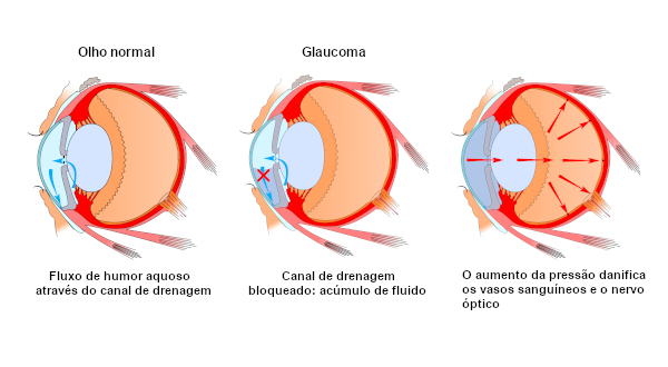 Esquema ilustrativo sobre como ocorre o glaucoma no olho humano.