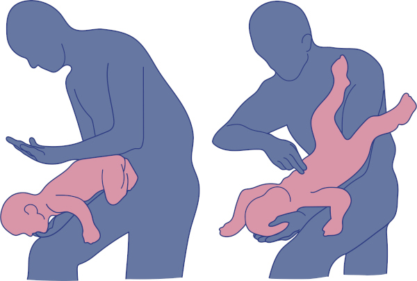 Ilustração representando o que fazer se um bebê engasgar.