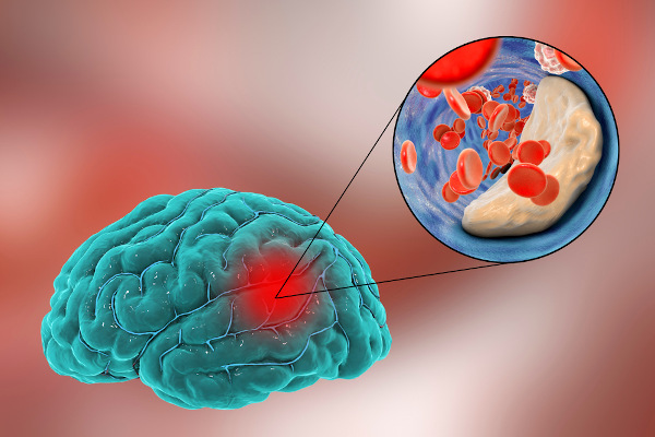 Ilustração da ocorrência de AVC isquêmico no cérebro.