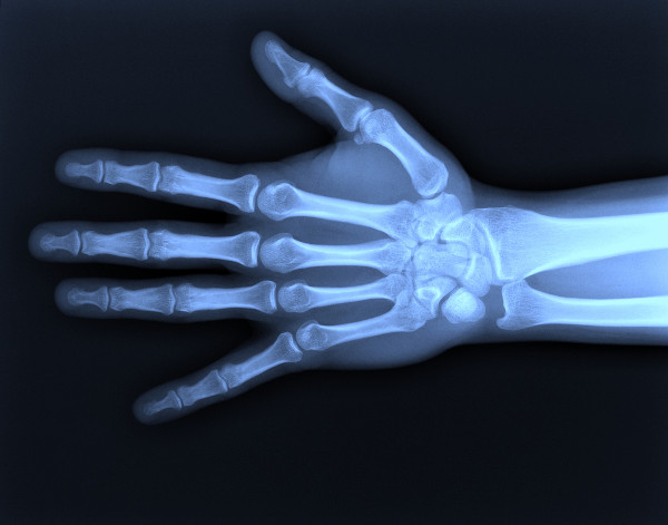 Radiografia dos ossos da mão.