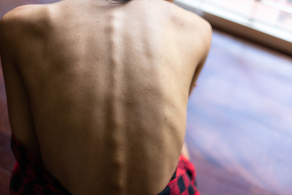 Costas de uma pessoa sofrendo de desnutrição, com as marcas visíveis dos ossos das costelas e da coluna espinhal.