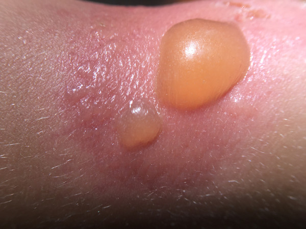 Bolhas na pele causadas por uma queimadura de segundo grau.