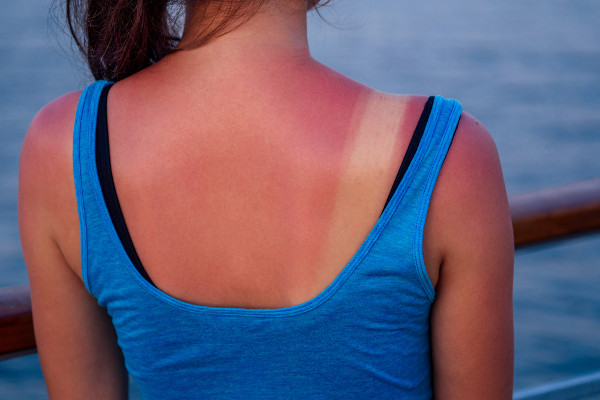 Marcas de queimadura de Sol na pele das costas de uma mulher.