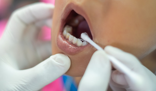Vista aproximada de dentista fazendo limpeza bucal com um composto de flúor.