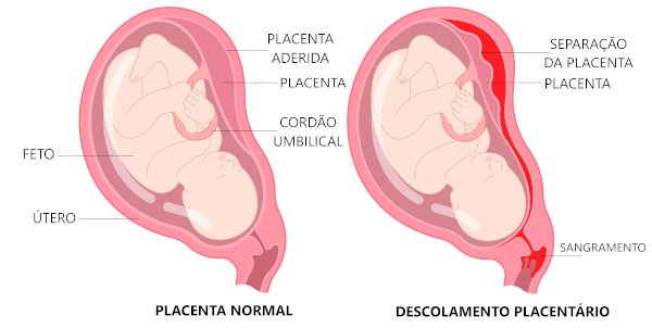 Esquema ilustrativo mostra posição normal da placenta e quando ocorre descolamento placentário.