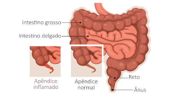 Ilustração de intestinos humanos com apêndice normal e inflamado, condição da apendicite.