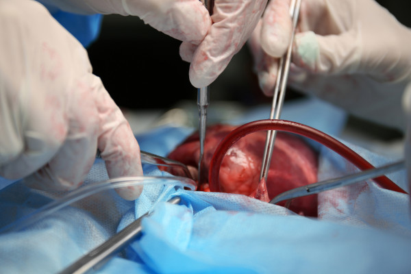 Médicos realizando transplante de coração.