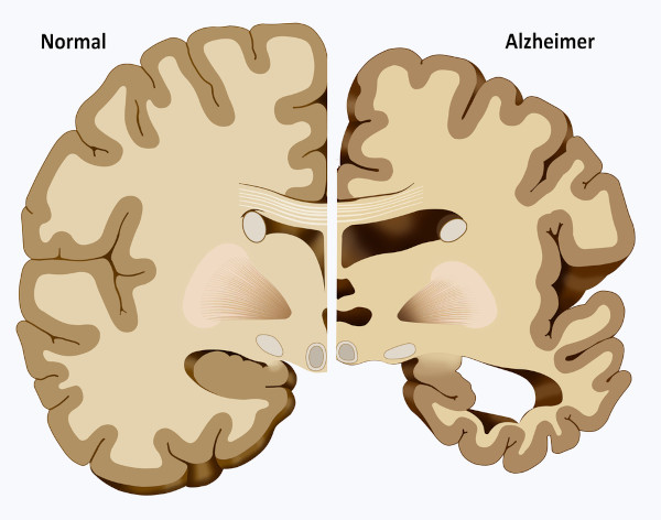 Ilustração de um cérebro com danos causados pelo Alzheimer, doença associada à demência.