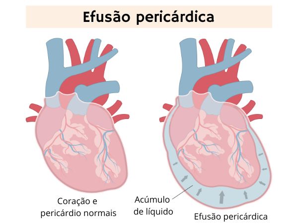 Esquema ilustrativo mostra coração afetado por efusão pericárdica.