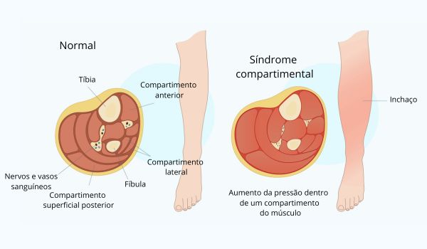 Perna normal e com inchaço resultante da síndrome compartimental, uma sequela da rabdomiólise.
