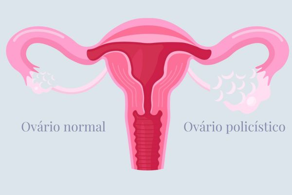 Sistema reprodutor feminino afetado pela síndrome dos ovários policísticos.