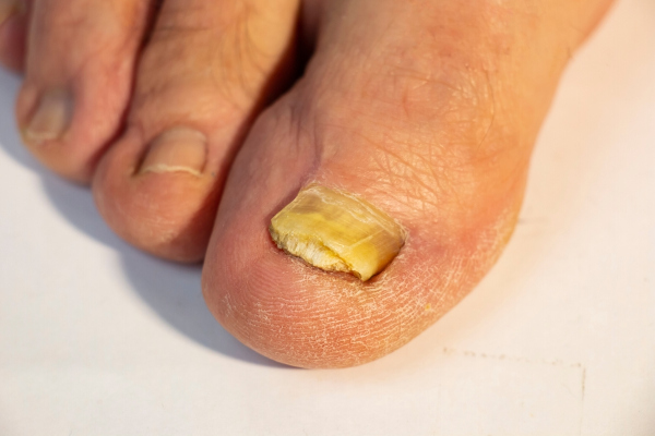 Unhas de um pé afetado por onicomicose, uma doença causada por fungos.