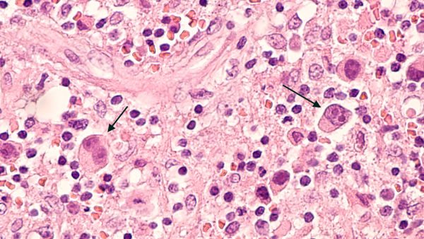 Imagem de microscopia de um linfoma de Hodgkin.
