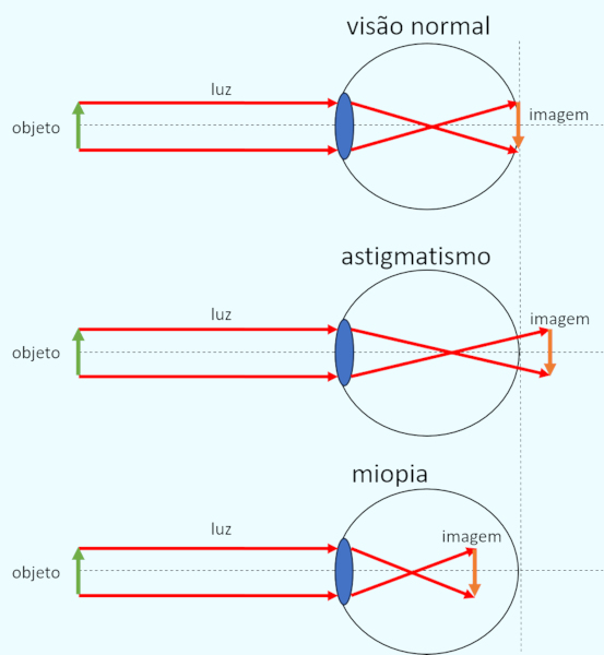 Dispersão da luz em diversas componentes. Esquema ilustrativo mostra como se dá a reflação da luz no globo ocular de acordo com os problemas de visão.