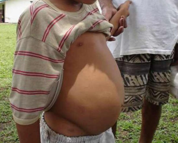 Ventre inchado de uma criança acometida pela verminose conhecida como barriga d’agua ou esquistossomose.