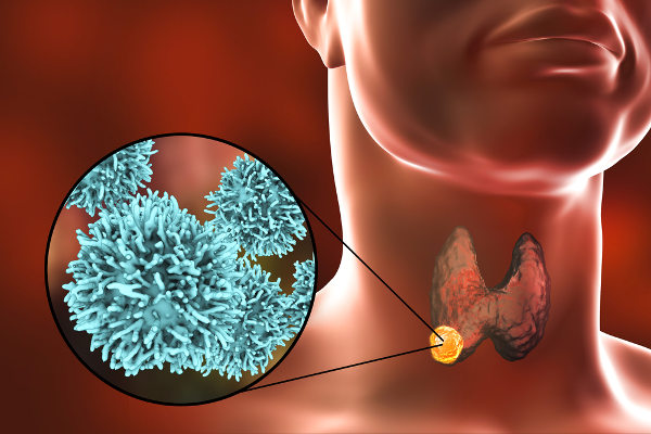 Representação de uma célula cancerígena no corpo humano.