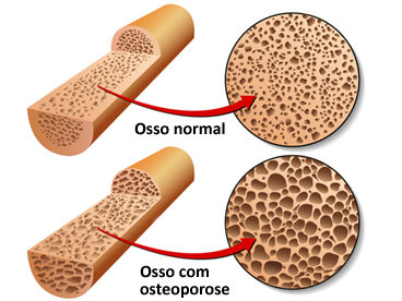 Osteoporose em osso com carência de cálcio