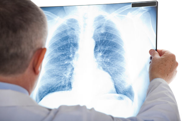 Médico olhando um raio-x em referência à embolia pulmonar.
